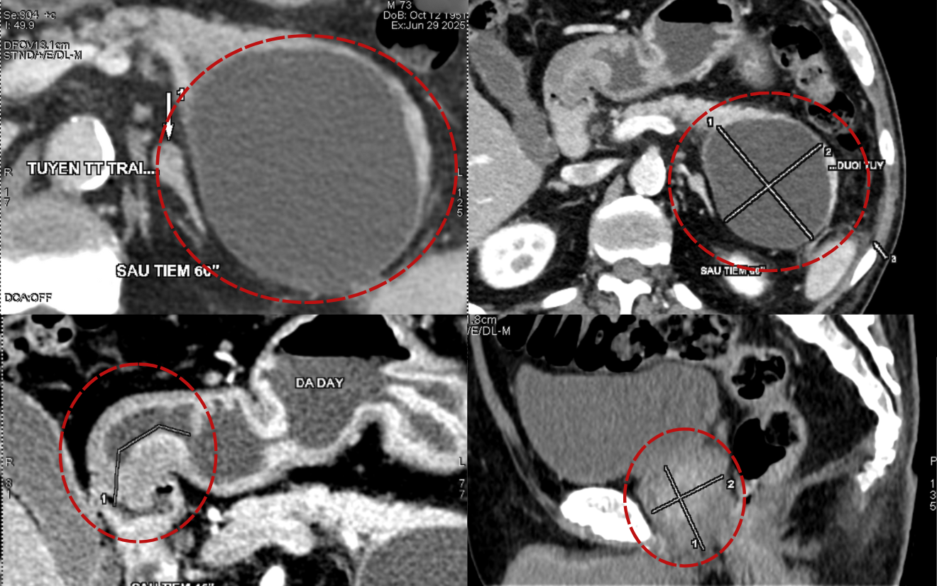 Kết quả chụp CT phát hiện bệnh nhân có tổn thương tiêu hóa đa cơ quan Kết quả chụp CT phát hiện bệnh nhân có tổn thương tiêu hóa đa cơ quan