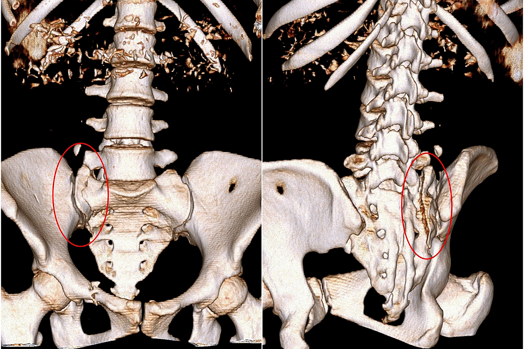 Dựng hình 3D phần gãy phức tạp cánh xương cùng của người phụ nữ. Dựng hình 3D phần gãy phức tạp cánh xương cùng của người phụ nữ.