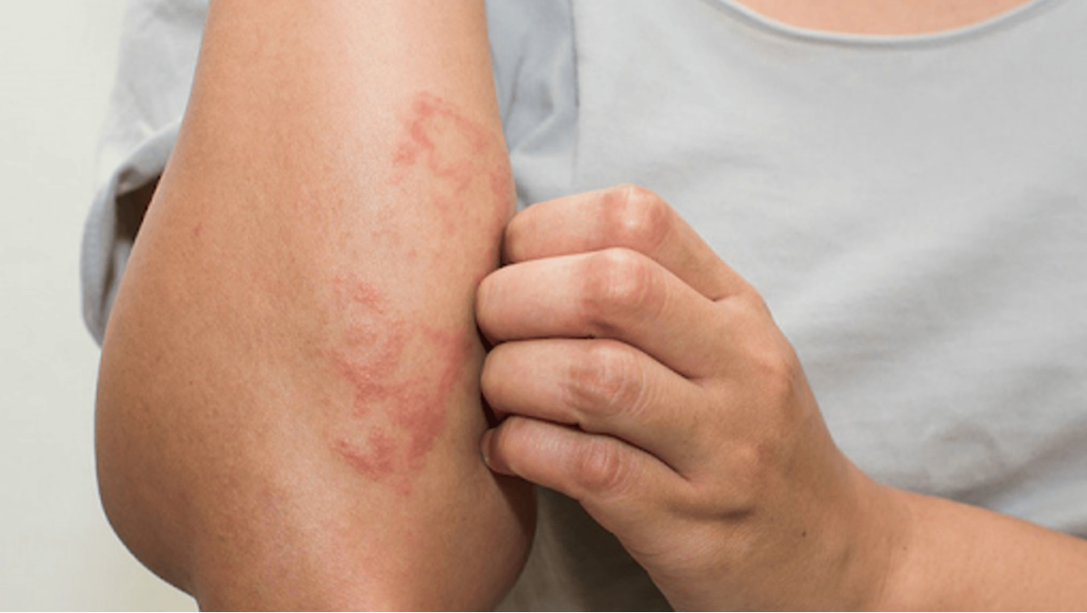 Dị ứng sau bơi lội: Đừng xem nhẹ làn da nhạy cảm