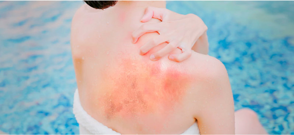Dị ứng sau khi bơi lội khiến người bệnh khó chịu, dễ gây biến chứng về da