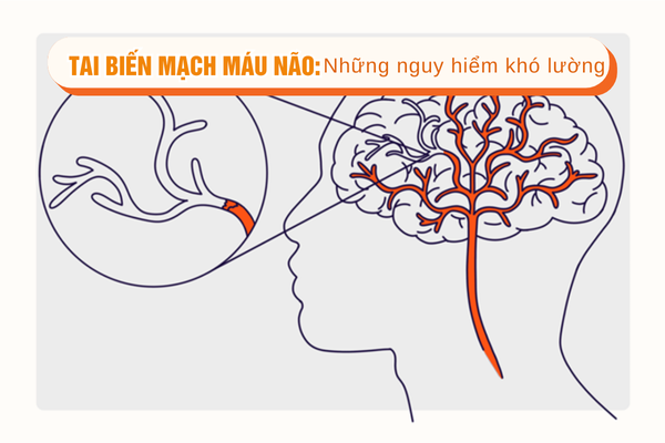 Tai biến mạch máu não: Những nguy hiểm khó lường