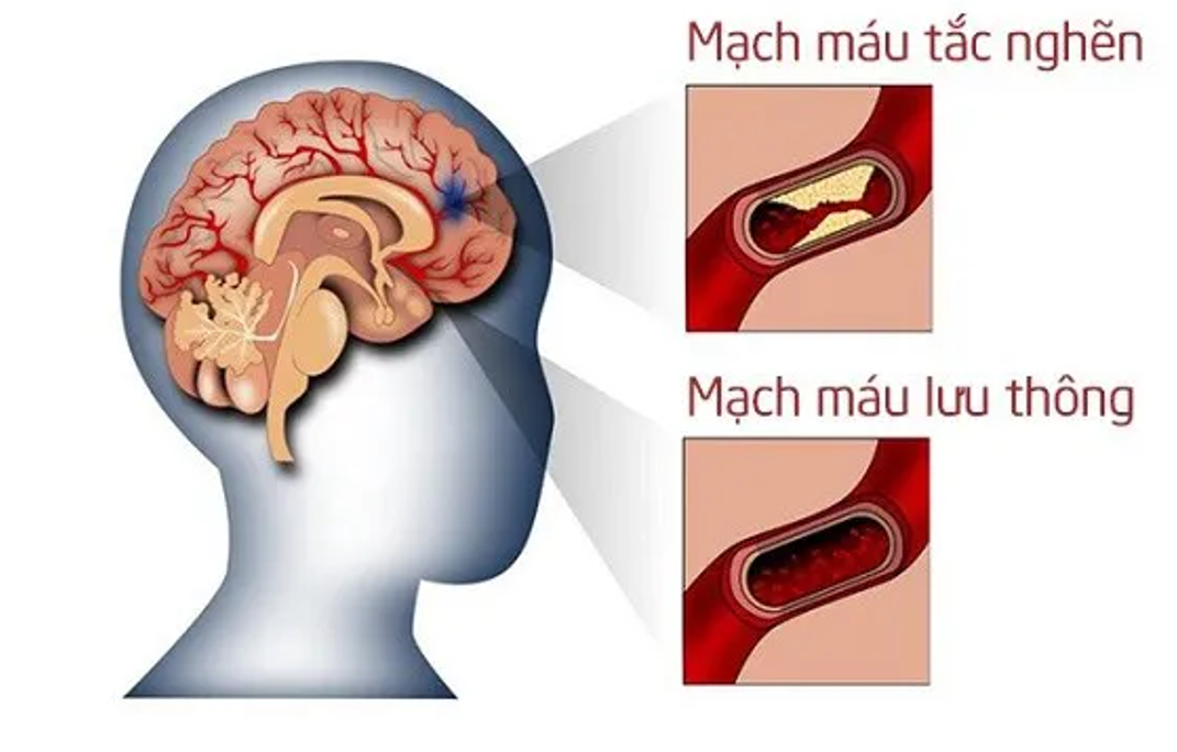 Cơn thiếu máu não thoáng qua là 1 dạng đột quỵ thường gặp
