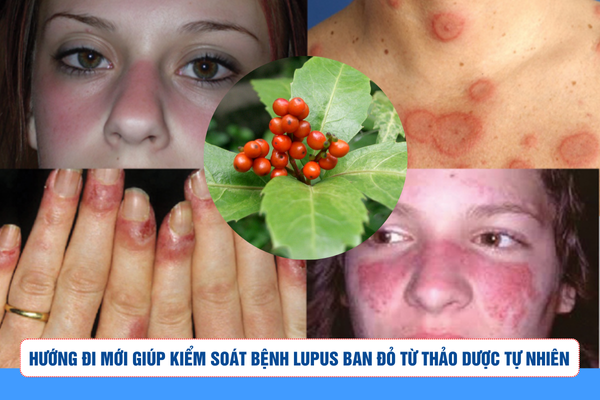 Hướng đi mới giúp kiểm soát bệnh lupus ban đỏ từ thảo dược tự nhiên