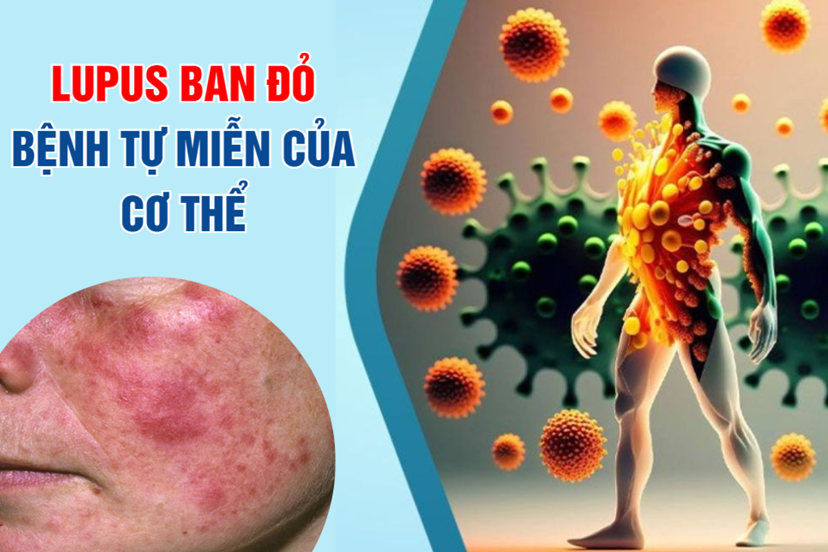 Lupus ban đỏ khiến hệ miễn dịch mất kiểm soát, gây viêm đa cơ quan