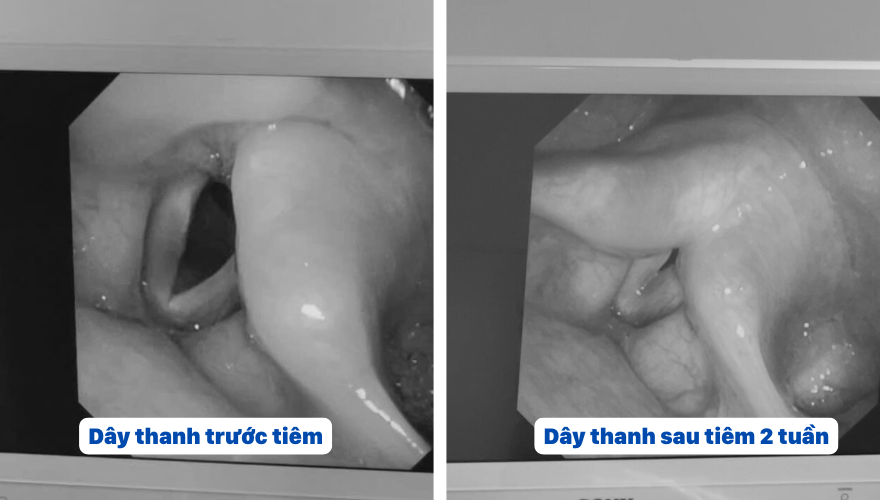 Dây thanh sau 2 tuần tiêm đã khép kín so với trước tiêm