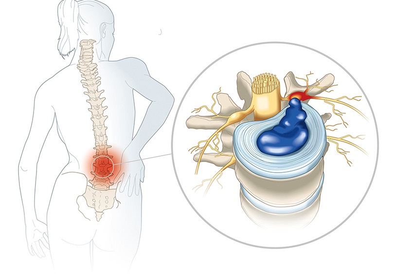 Thoát vị đĩa đệm L5 S1 – Nguyên nhân, triệu chứng và cách điều trị
