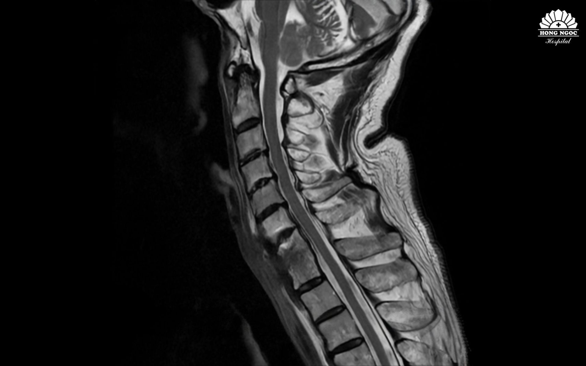 Dải xơ và ổ viêm đã được xử lý, lấy lại đường cong sinh lý, làm vững cột sống cổ