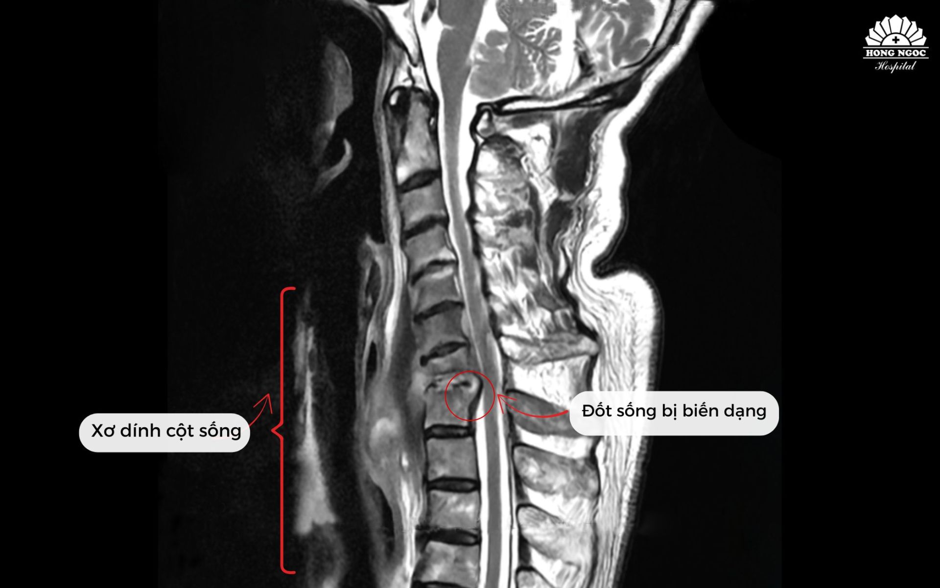 Không thể xoay ngửa cổ vì bệnh hiếm, giáo sư người Nhật sang Việt Nam phẫu thuật thành công