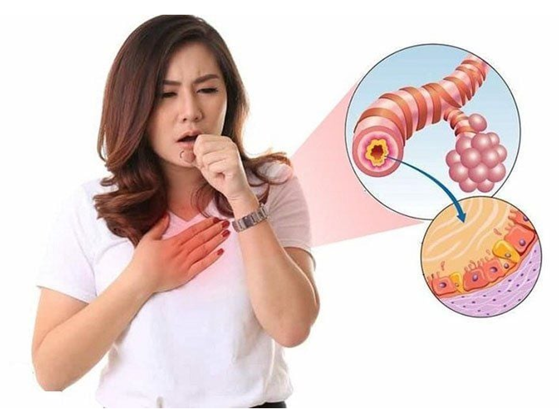 Viêm phế quản là một bệnh đường hô hấp đáng lo ngại