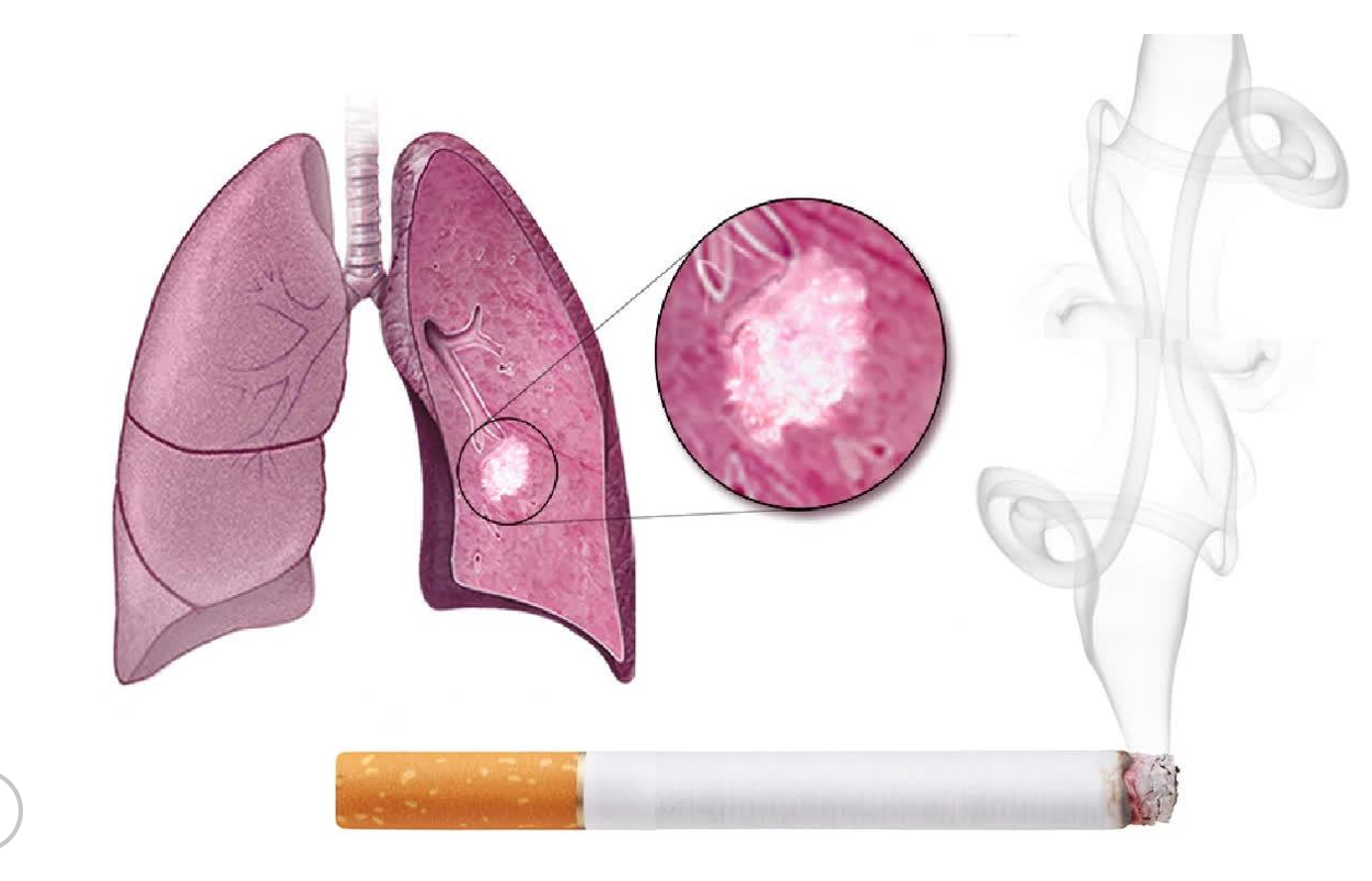 Bệnh viêm phế quản mạn tính: Dấu hiệu và cách xử trí!