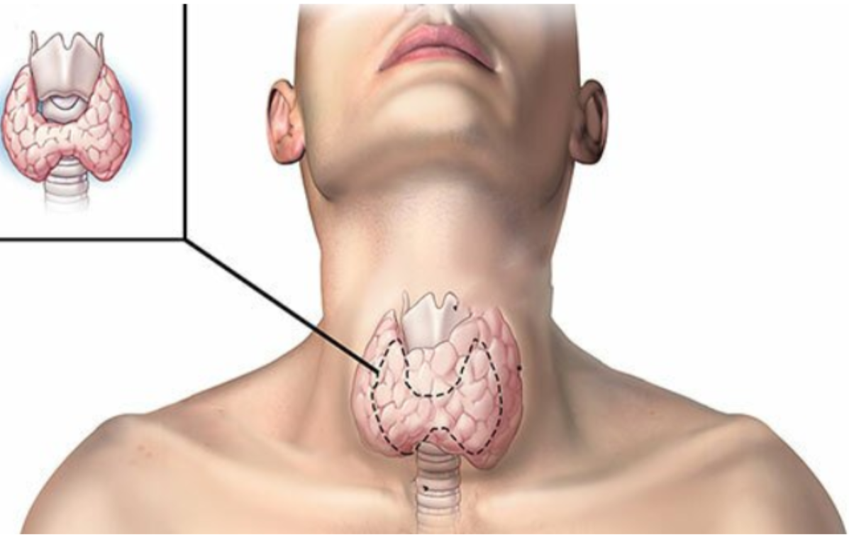 Bướu cổ do thiếu i-ốt là sự gia tăng kích thước bất thường của tuyến giáp