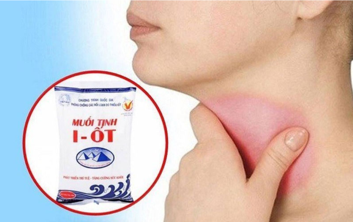 Thiếu i-ốt là nguyên nhân chính gây bướu cổ