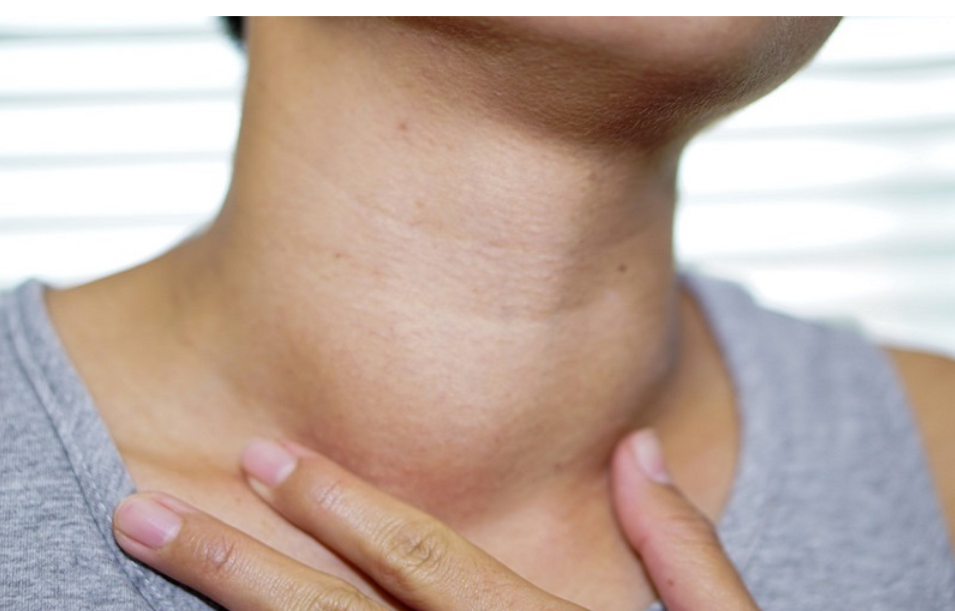 Bướu phát triển to, gây biến dạng cổ, mất thẩm mỹ