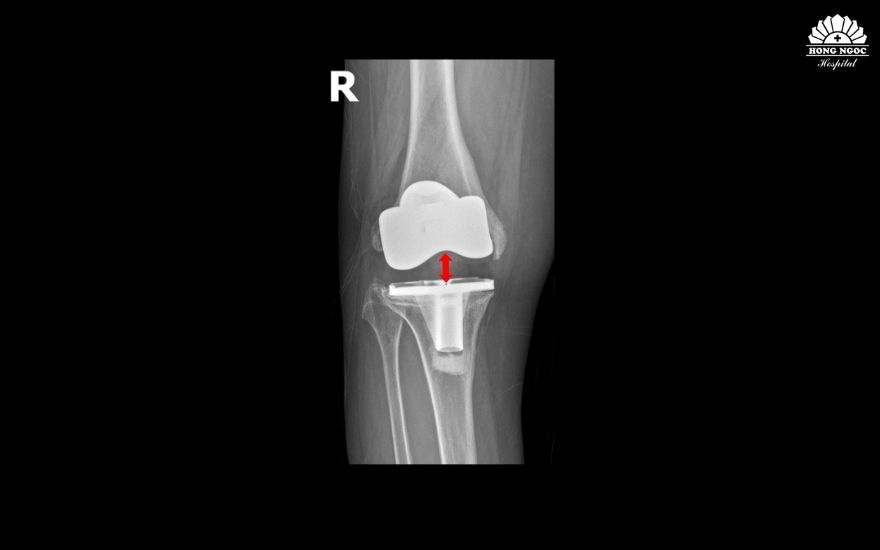 Khớp gối nhân tạo lỏng lẻo, di lệch khỏi ổ khớp