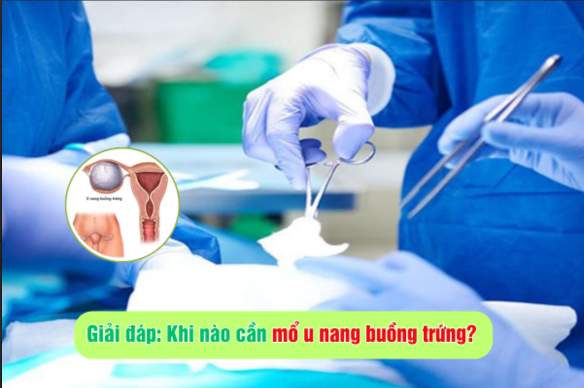 Khi nào cần mổ u nang buồng trứng?