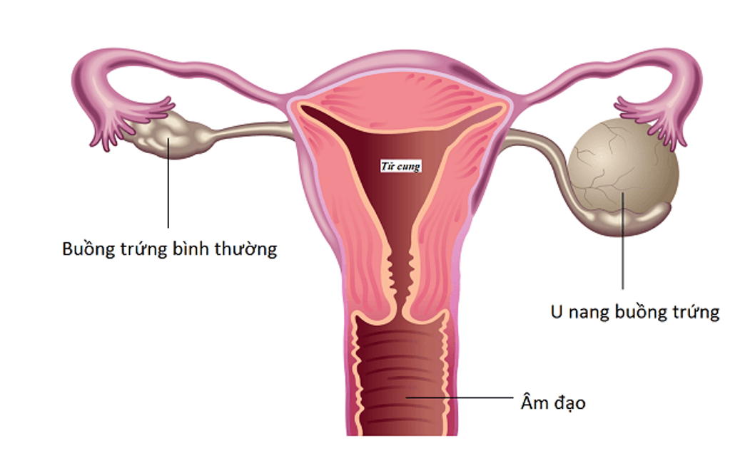 U nang buồng trứng là bệnh lý thường gặp ở phụ nữ sinh sản