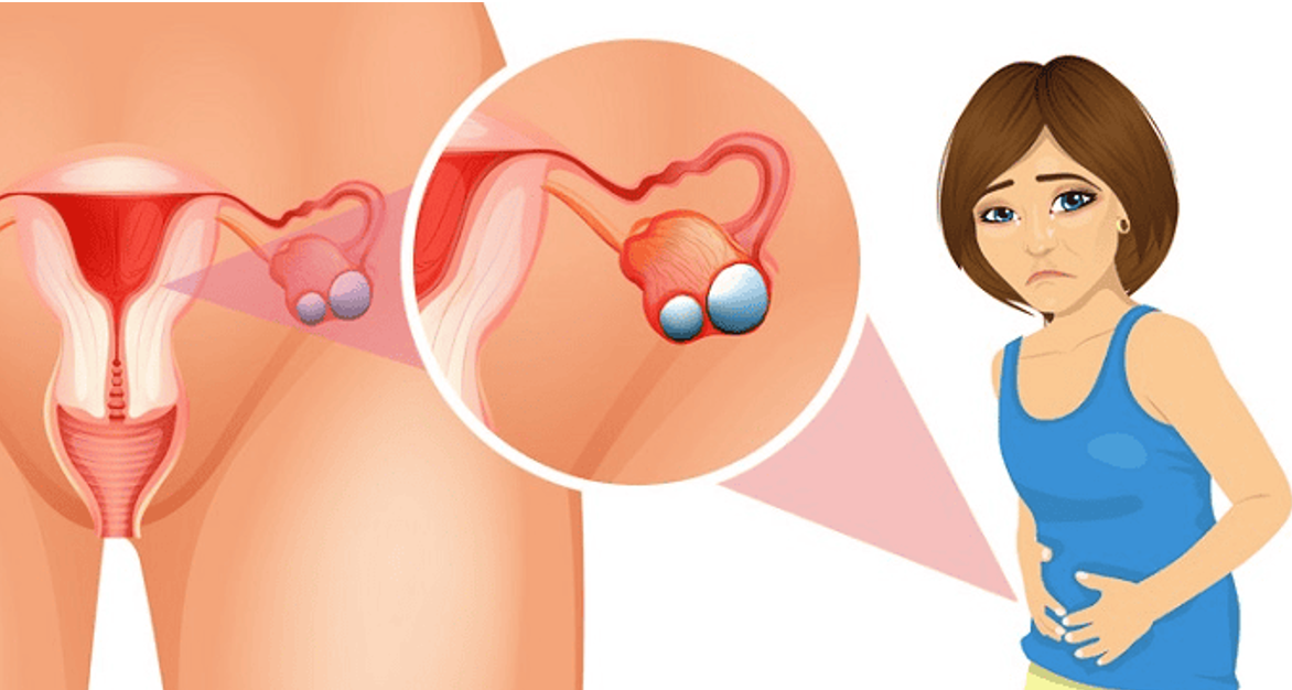 U nang buồng trứng gây đau đớn dữ dội sẽ được chỉ định phẫu thuật