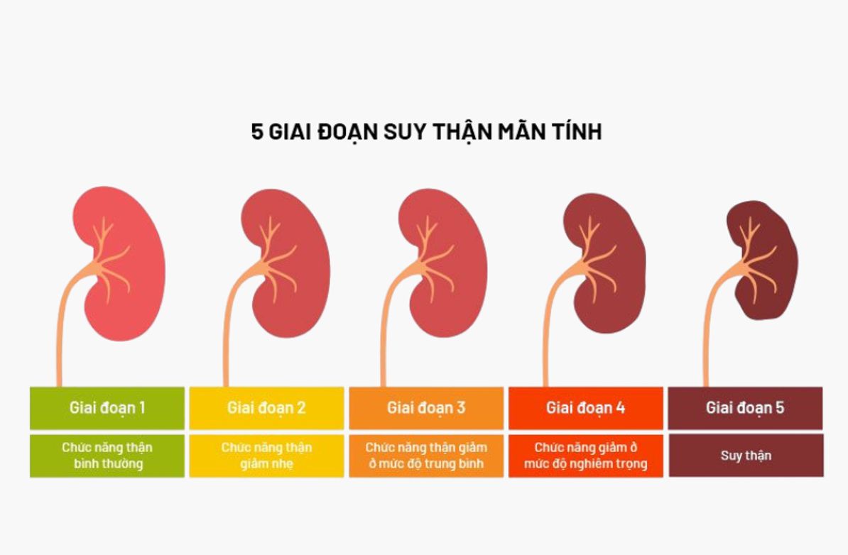Suy thận độ 2 là 1 trong 5 giai đoạn suy thận mạn