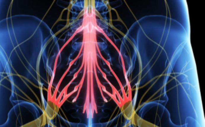 Hội chứng chùm đuôi ngựa là biến chứng thường gặp của thoát vị đĩa đệm