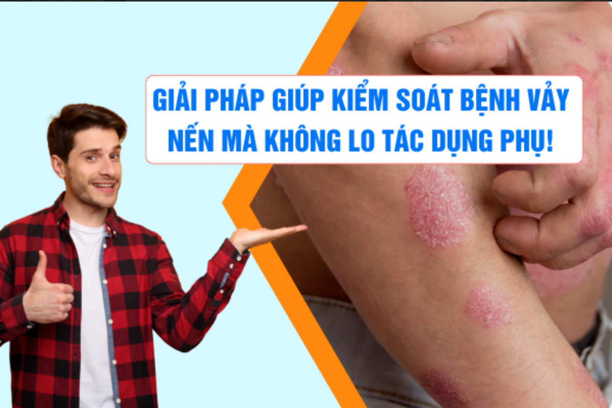 Giải pháp giúp kiểm soát vảy nến mà không lo tác dụng phụ