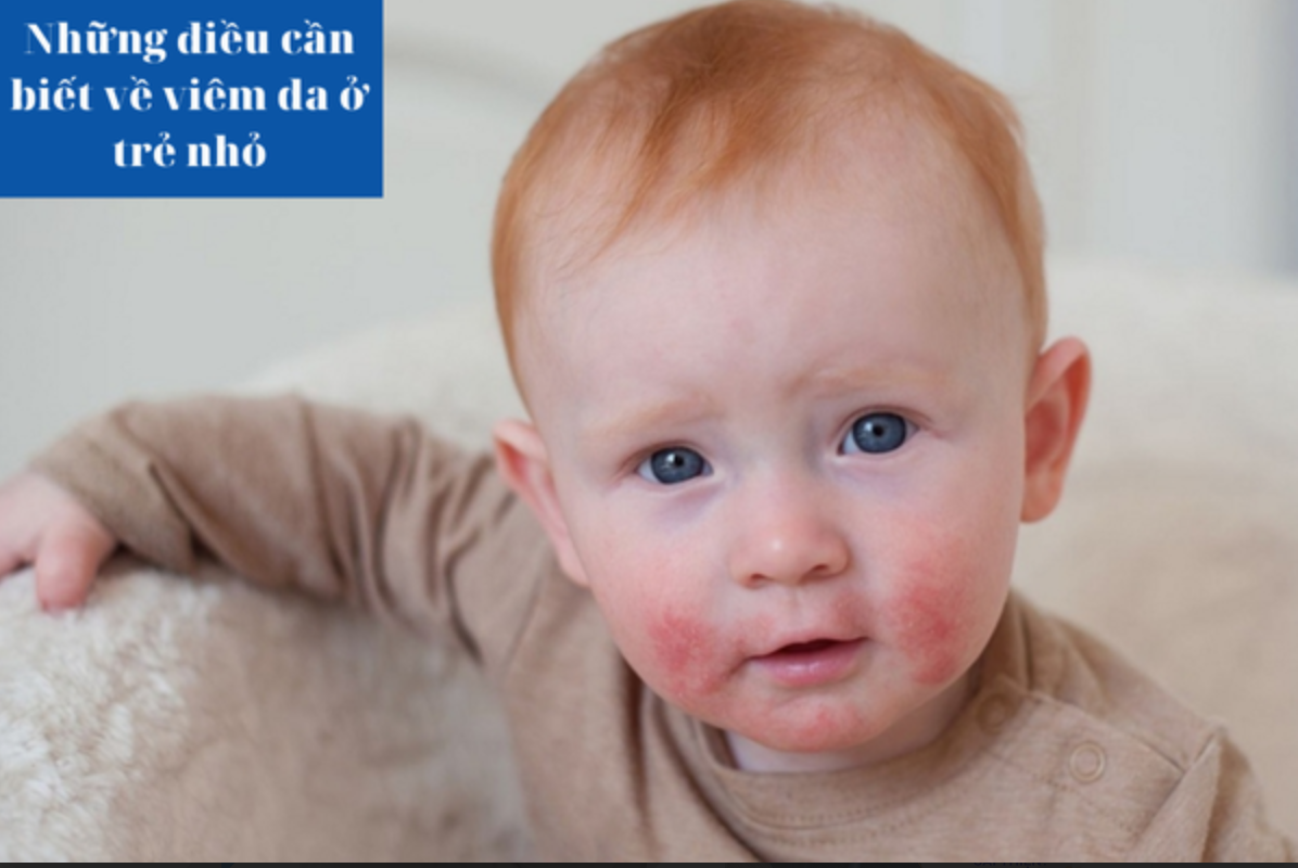Những điều cần biết về viêm da ở trẻ nhỏ