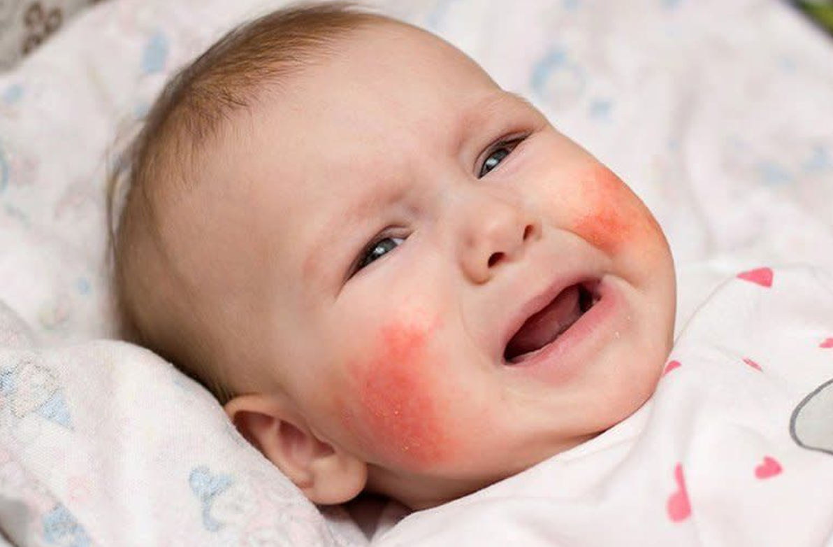 Viêm da là tình trạng da bé bị viêm đỏ, ngứa, bong tróc hoặc nổi mụn nước Viêm da là tình trạng da bé bị viêm đỏ, ngứa, bong tróc hoặc nổi mụn nước