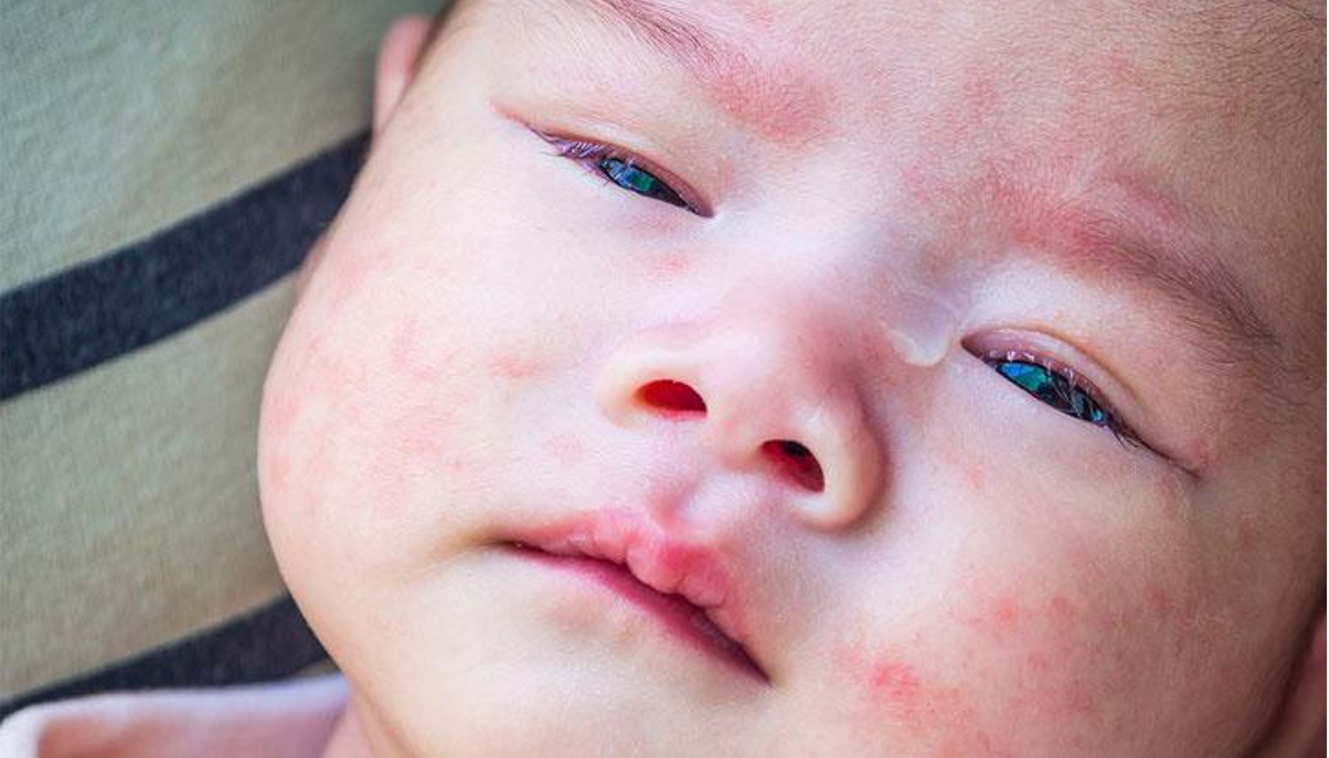 Hàng rào bảo vệ da bé chưa hoàn thiện nên dễ mắc viêm da Hàng rào bảo vệ da bé chưa hoàn thiện nên dễ mắc viêm da