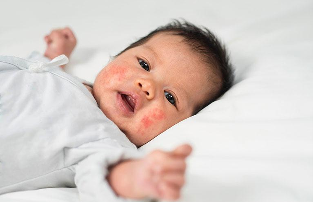 Bé có thể bị nhiễm trùng da hoặc lở loét khi bị viêm da Bé có thể bị nhiễm trùng da hoặc lở loét khi bị viêm da