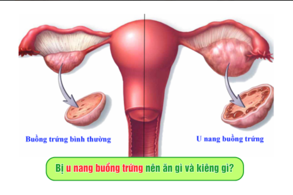 Bị u nang buồng trứng nên ăn gì và kiêng gì?