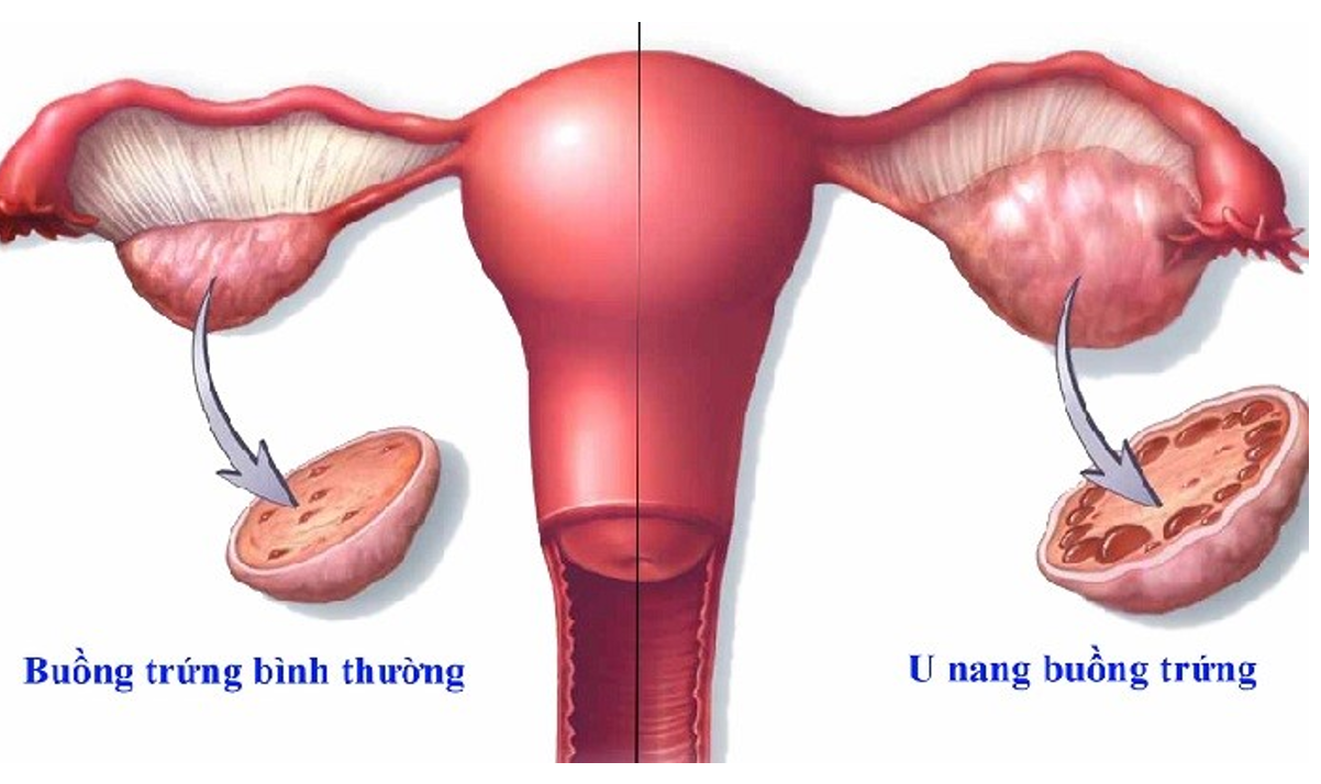 U nang buồng trứng thường gặp ở phụ nữ độ tuổi sinh sản U nang buồng trứng thường gặp ở phụ nữ độ tuổi sinh sản