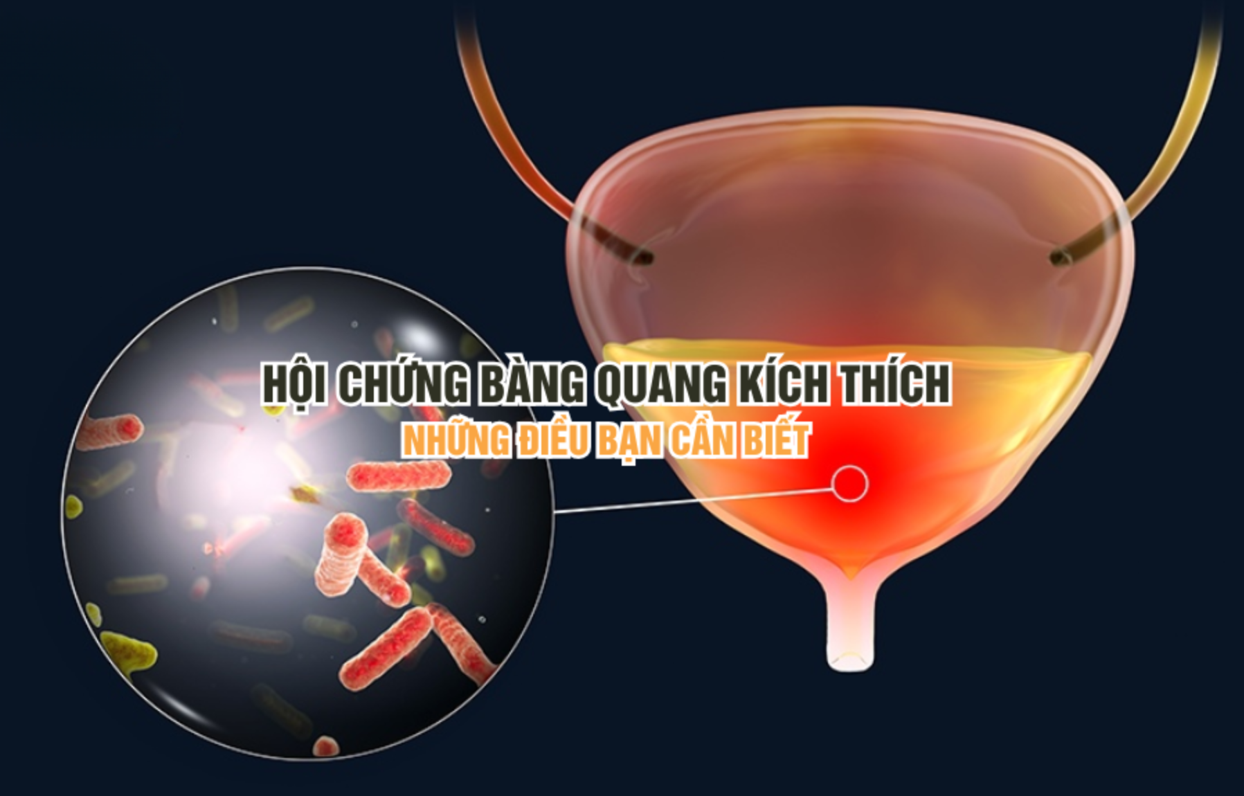 Hội chứng bàng quang kích thích - Thông tin bạn cần biết