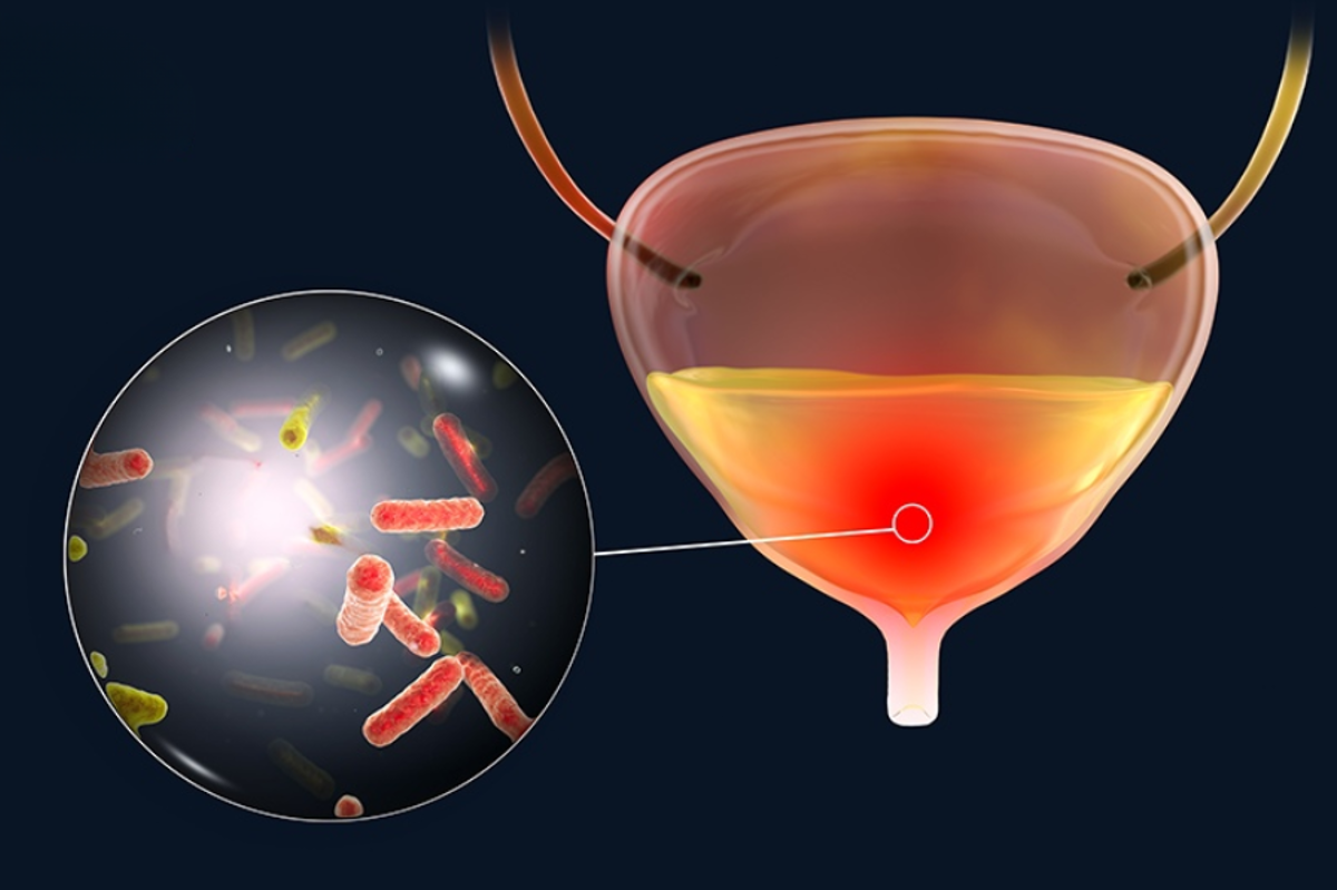 Hội chứng bàng quang kích thích có thể là kết quả của nhiễm khuẩn tiết niệu Hội chứng bàng quang kích thích có thể là kết quả của nhiễm khuẩn tiết niệu