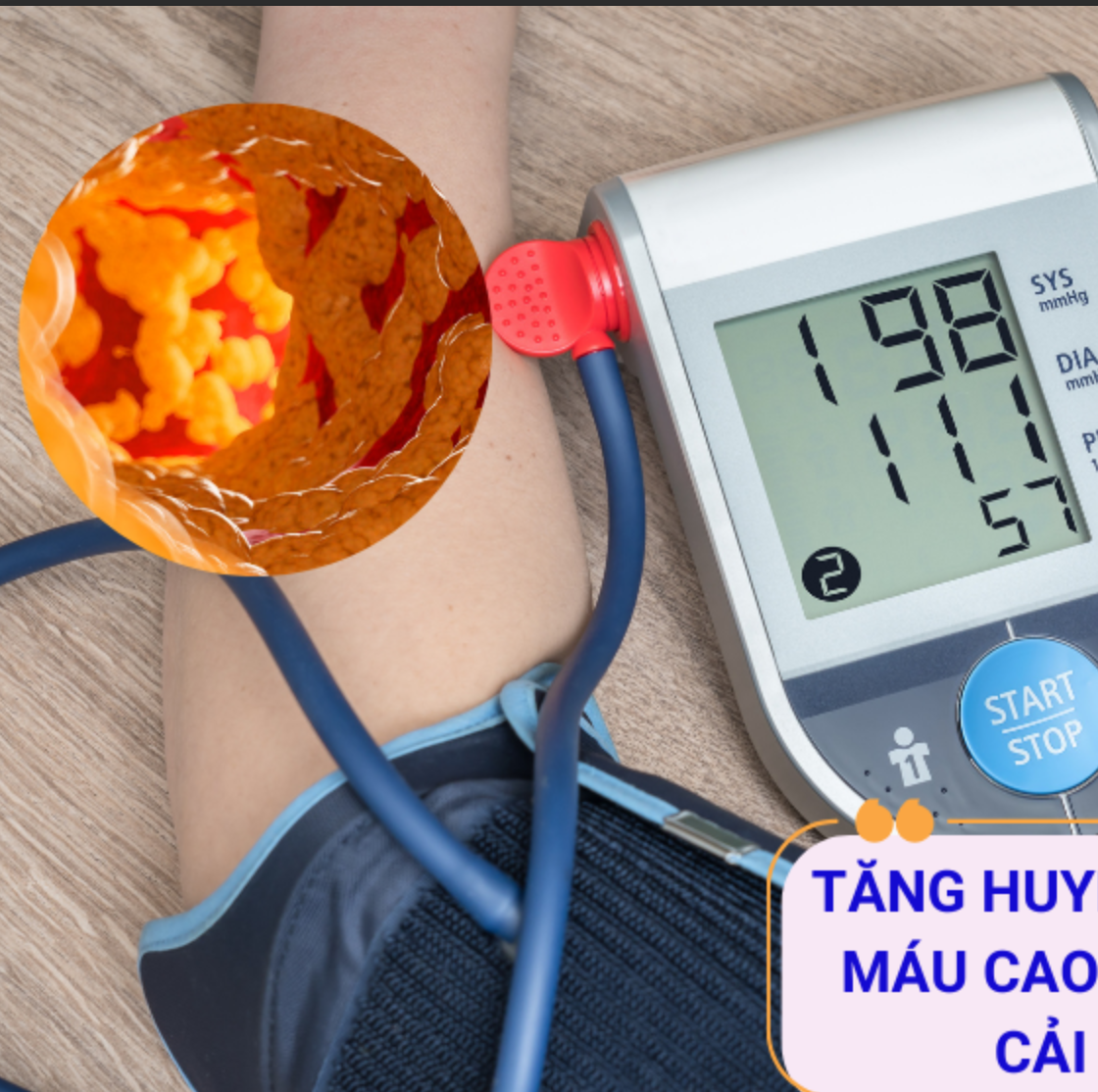 Làm thế nào để cải thiện tăng huyết áp kèm mỡ máu cao?