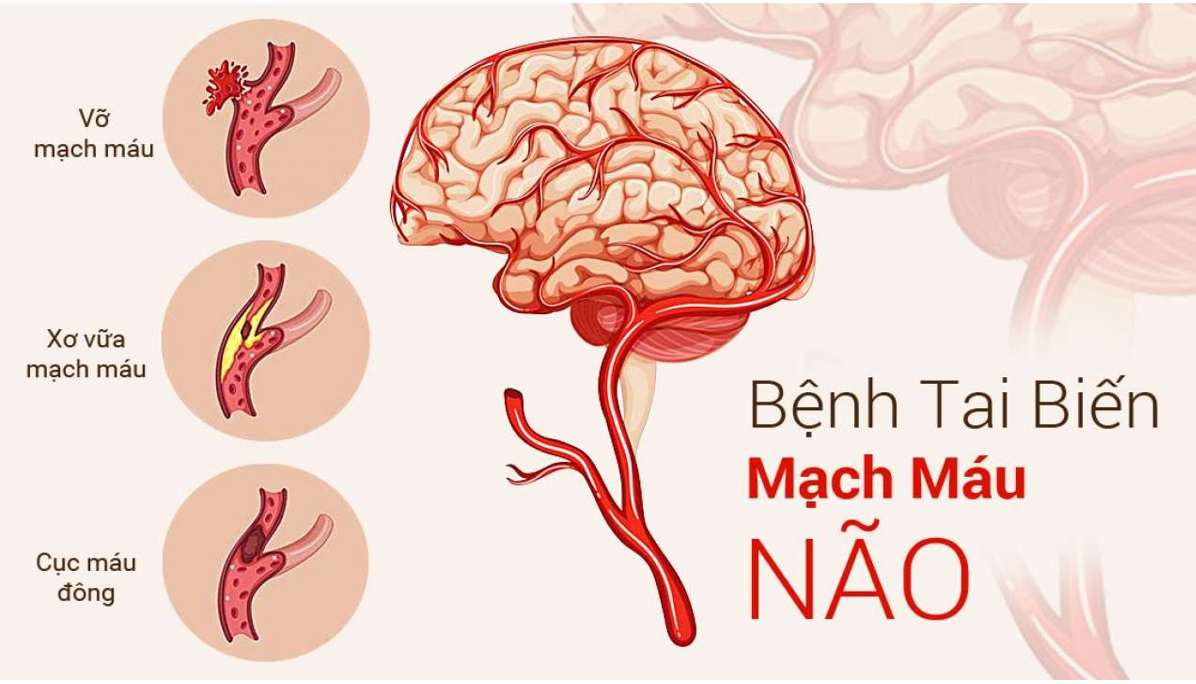 Tai biến mạch máu não có thể để lại nhiều di chứng nghiêm trọng Tai biến mạch máu não có thể để lại nhiều di chứng nghiêm trọng