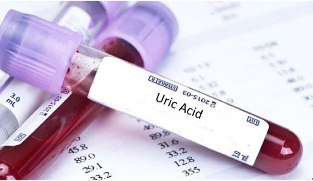 Acid uric khi không được kiểm soát tốt sẽ khiến bệnh gút nặng hơn Acid uric khi không được kiểm soát tốt sẽ khiến bệnh gút nặng hơn