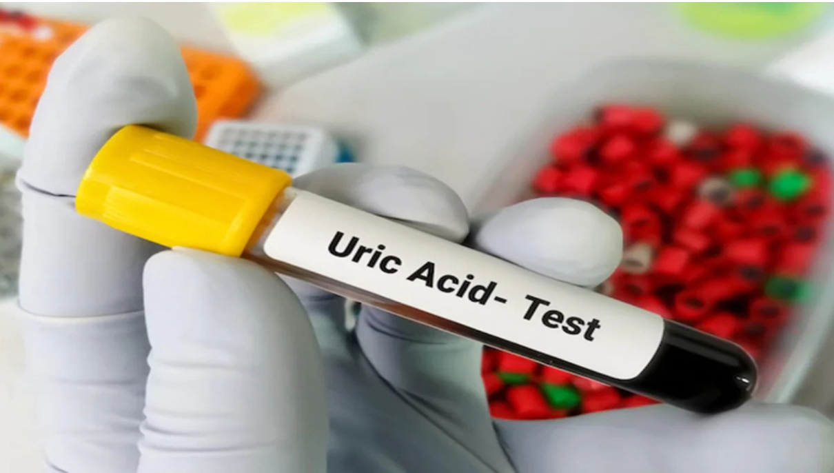 Chỉ số acid uric nếu được kiểm soát tốt sẽ giúp ngăn ngừa bệnh gút tái phát và tiến triển Chỉ số acid uric nếu được kiểm soát tốt sẽ giúp ngăn ngừa bệnh gút tái phát và tiến triển