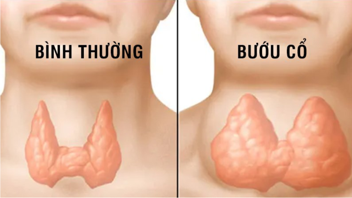 Bướu cổ lành tính có cần mổ không? Cách nhận biết và xử lý an toàn