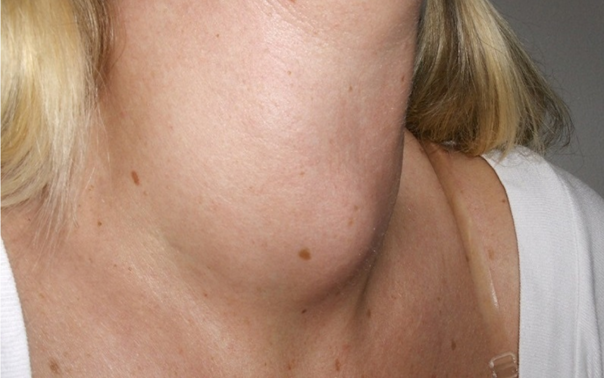 Bướu phát triển to, gây biến dạng cổ, mất thẩm mỹ sẽ phải mổ Bướu phát triển to, gây biến dạng cổ, mất thẩm mỹ sẽ phải mổ