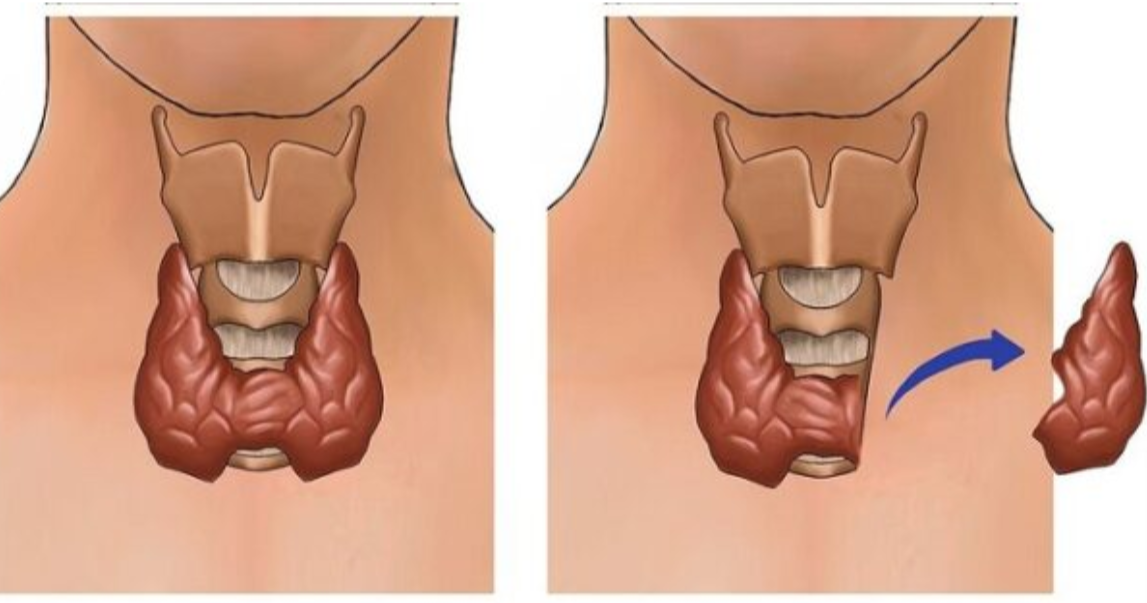 Phẫu thuật tuyến giáp chỉ nên thực hiện khi thật sự cần thiết Phẫu thuật tuyến giáp chỉ nên thực hiện khi thật sự cần thiết