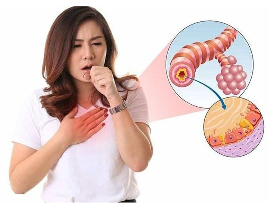Viêm phế quản mạn tính là một bệnh đường hô hấp đáng lo ngại