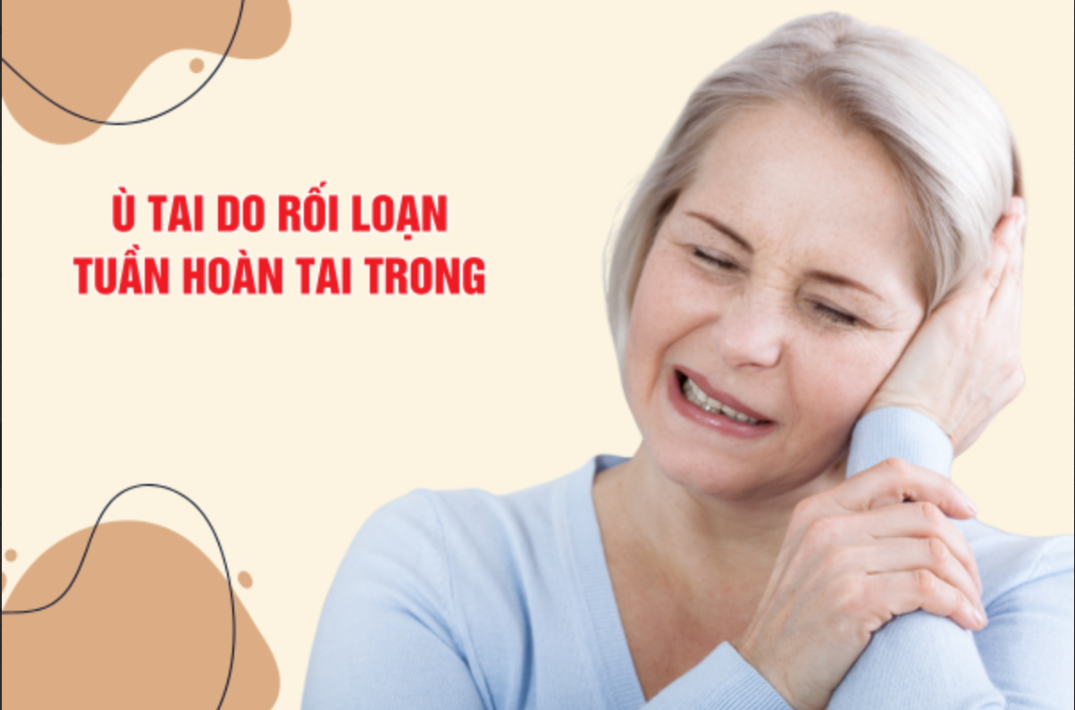 Ù tai do rối loạn tuần hoàn tai trong: Nguyên nhân, triệu chứng và cách điều trị hiệu quả