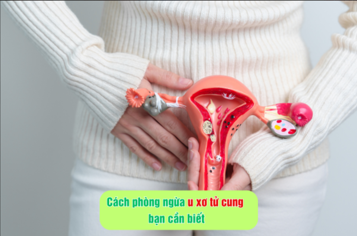 Cách phòng ngừa u xơ tử cung bạn cần biết