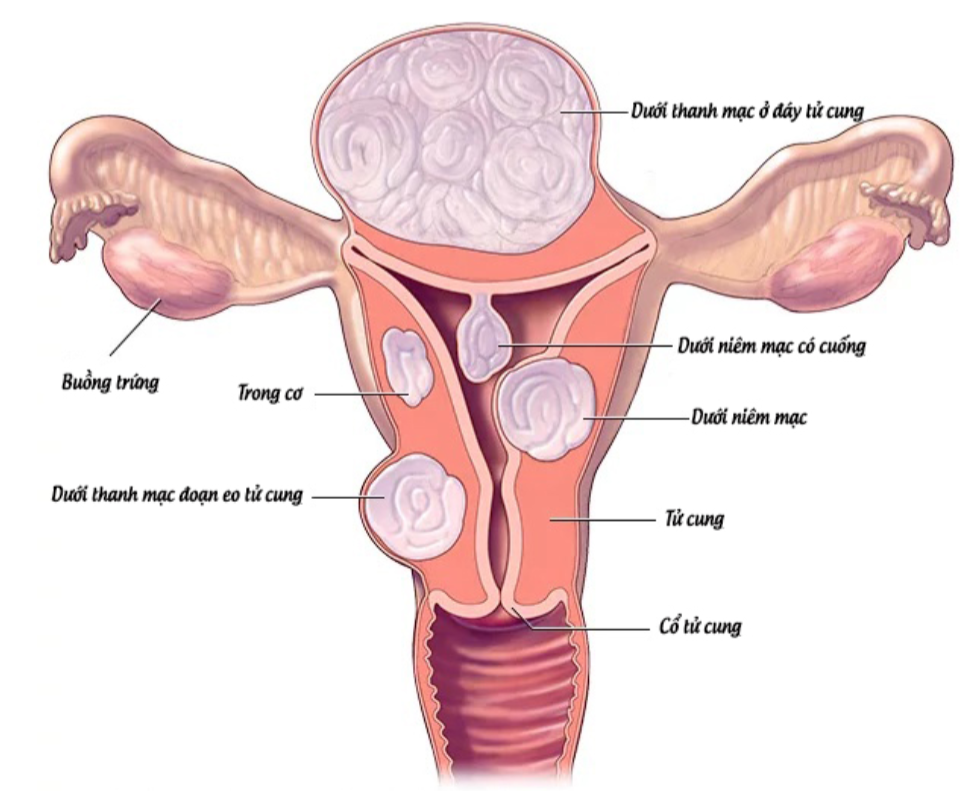 U xơ tử cung không phải tình trạng hiếm gặp ở phụ nữ tuổi sinh sản