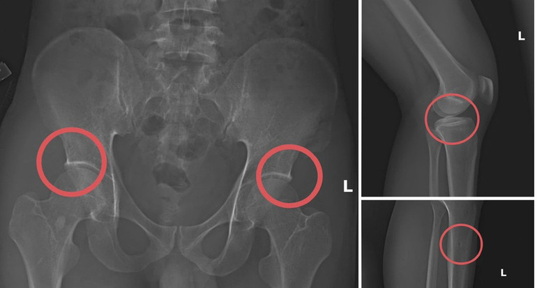 Bản phim chụp XQ một số tổn thương xương do đối tượng tạo ra nhằm trục lợi tiền bảo hiểm nhân thọ.