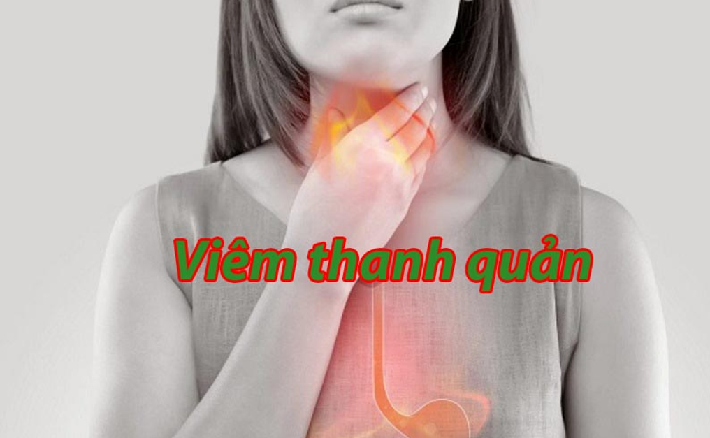 Viêm thanh quản gây ra nhiều triệu chứng khó chịu