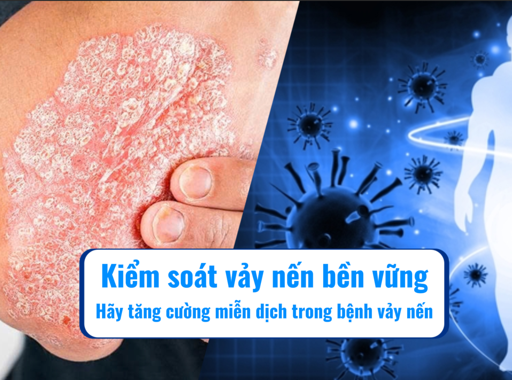 Kiểm soát vảy nến bền vững – Hãy tăng cường miễn dịch