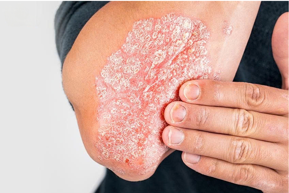 Biểu hiện điển hình của bệnh vảy nến