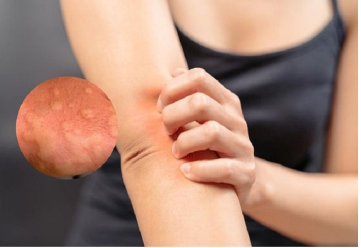 Ngứa về đêm khiến người bệnh khó chịu và nhanh chóng suy giảm sức khỏe Ngứa về đêm khiến người bệnh khó chịu và nhanh chóng suy giảm sức khỏe