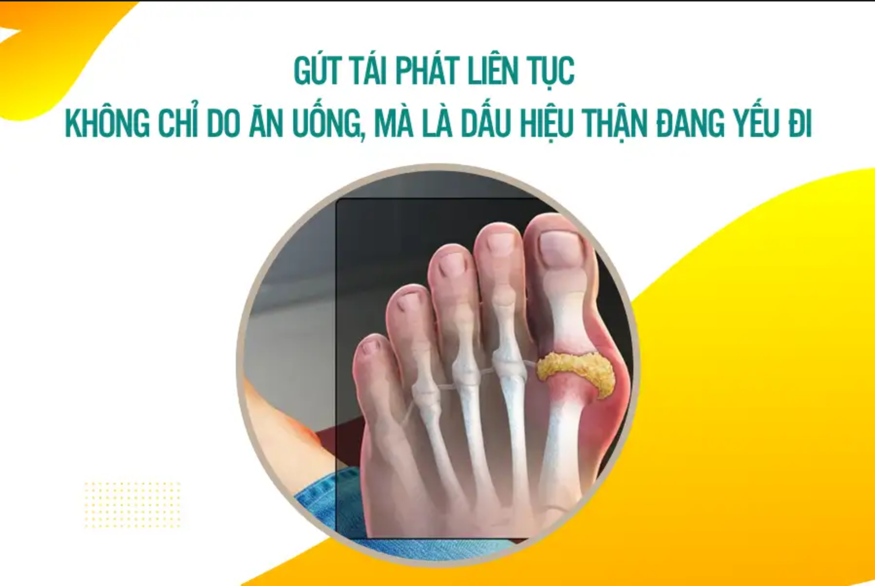 Gút tái phát liên tục – không chỉ do ăn uống, mà là dấu hiệu thận đang yếu đi