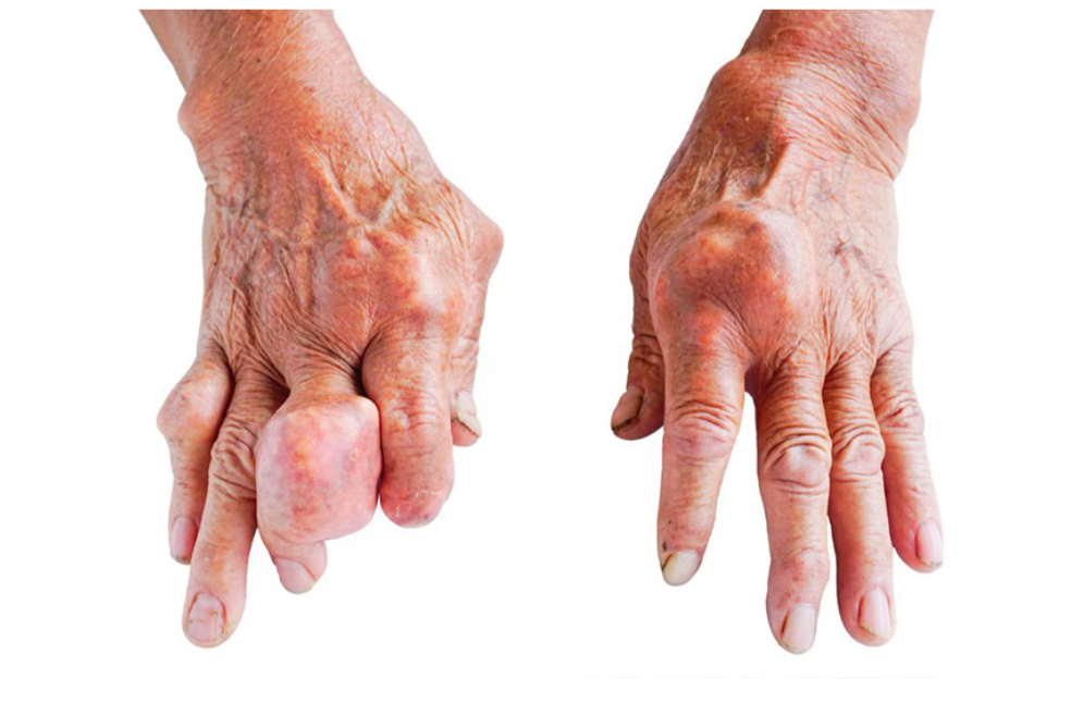 Bệnh gút vẫn có thể tiến triển nặng ngay cả khi bạn kiêng khem kỹ lưỡng